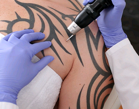 Tire suas dúvidas sobre remoção de tatuagem