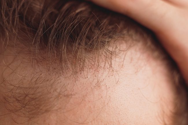 Queda de cabelo em homens: quais as principais causas da calvície e os melhores tratamentos