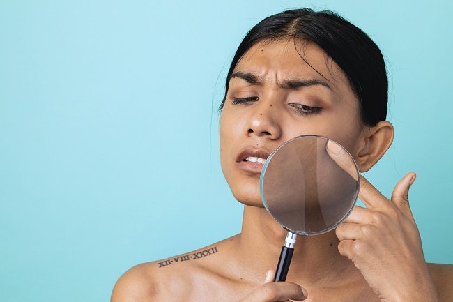 Melasma: como eliminar essa mancha incômoda na sua pele?
